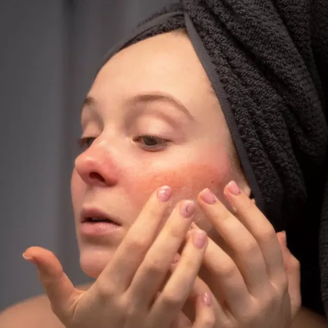 Pleť se sklony ke kuperóze